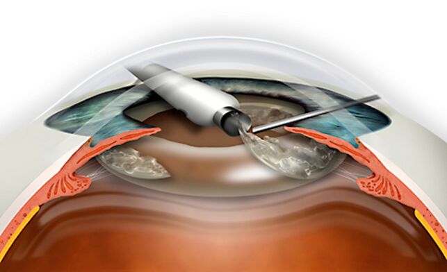 Refractive lens replacement is performed through micronadle, which excludes blood loss