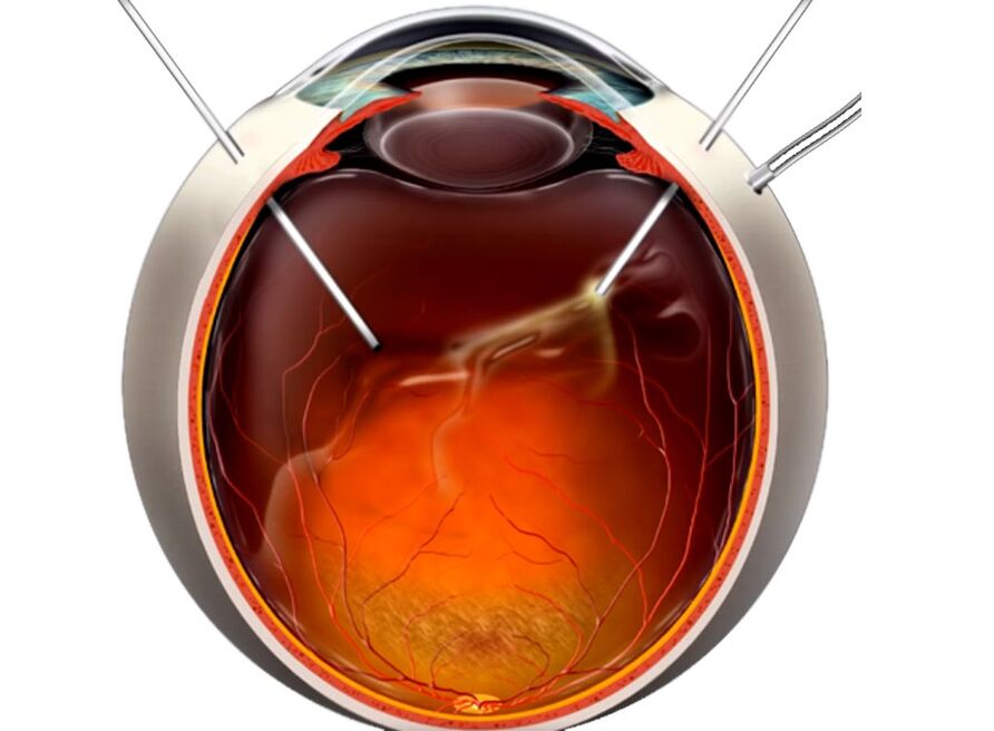 Vitectomy - a procedure shown by people when retinal exfoliation